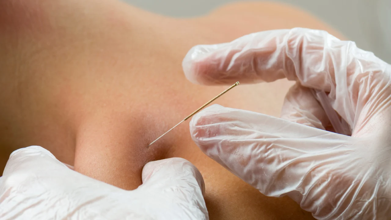 Patient receiving dry needling therapy for muscle pain at Total Musculoskeletal Care